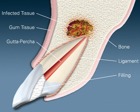 Dental cross-section diagram showing infected tooth with labeled anatomical structures and endodontic treatment area.