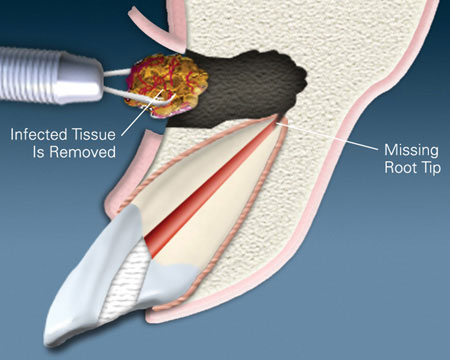 Endodontic procedure illustration showing infected tissue removal and missing root tip during root canal treatment.