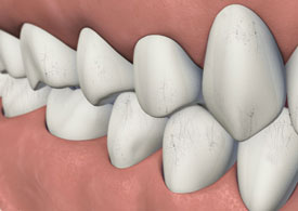 3D dental illustration showing crowded, misaligned teeth on pink gum background for endodontics education.