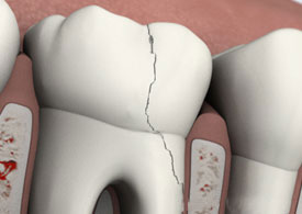 Cracked tooth model displaying fracture line between two white dental replicas on pink surface.
