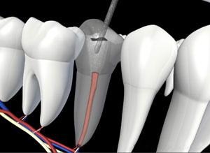 Dental implant diagram showing tooth structure with root canal treatment and surrounding teeth in cross-section view.