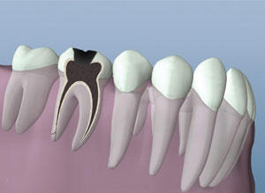 Dental model showing tooth cross-sections and endodontic treatment stages on pink base.