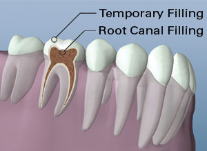 Dental diagram showing tooth cross-section with temporary and root canal fillings labeled.