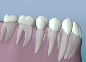 Dental illustration showing tooth anatomy with white crowns on pink gum tissue model.