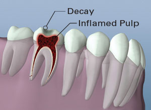 Dental diagram showing tooth decay and inflamed pulp in cross-section view of teeth.