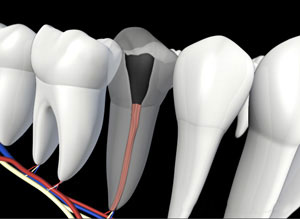 3D dental illustration showing tooth cross-section with root canal treatment visualization and surrounding teeth.