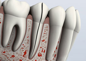 Dental endodontic instruments with red markings arranged in a row on white surface.