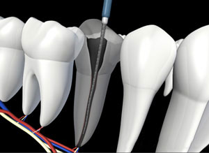3D dental illustration showing root canal treatment procedure with endodontic file inside tooth cross-section.