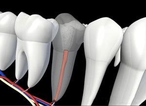 3D dental illustration showing tooth cross-section with root canal treatment diagram and surrounding teeth.