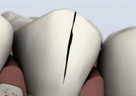 Dental model showing tooth with endodontic access opening for root canal treatment demonstration.